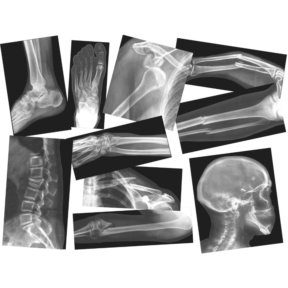 1015092 Broken Bones X-rays With Teacher Guide , Set - 15