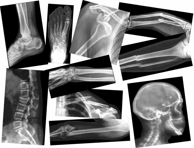 R 5914 Broken Bones X-rays 15 Pcs