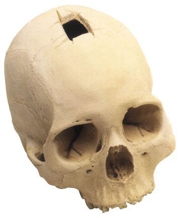 0202 Trephined Cranium