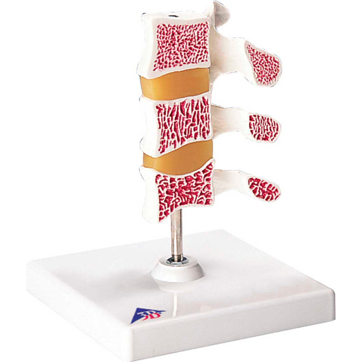 3B Anatomical Model - Deluxe Osteoporosis
