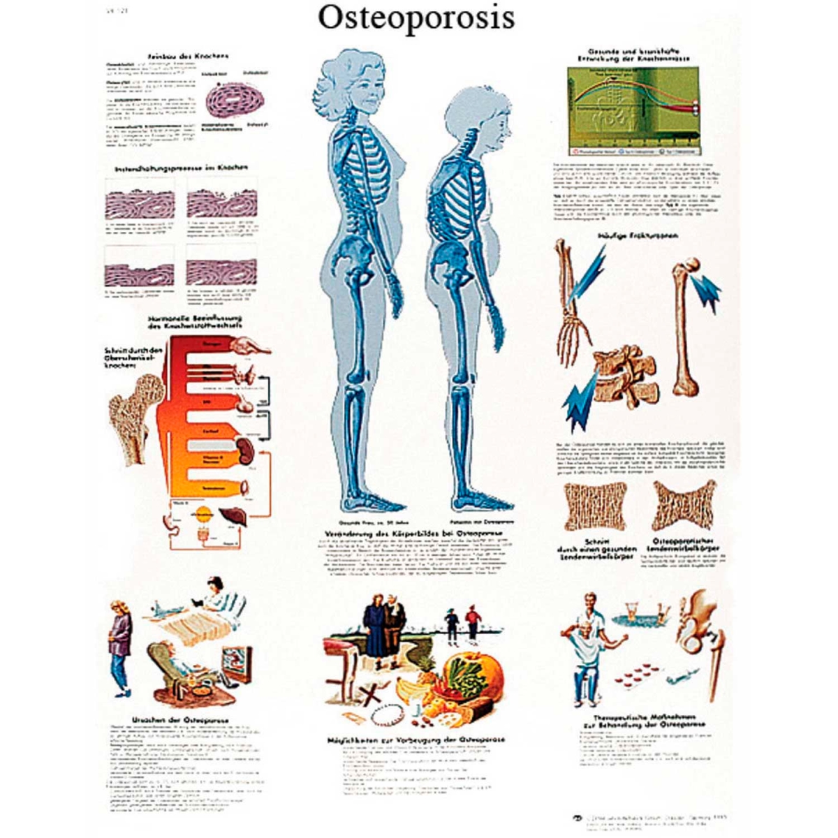 B2138005 3B Anatomical Chart - Osteoporosis, Laminated