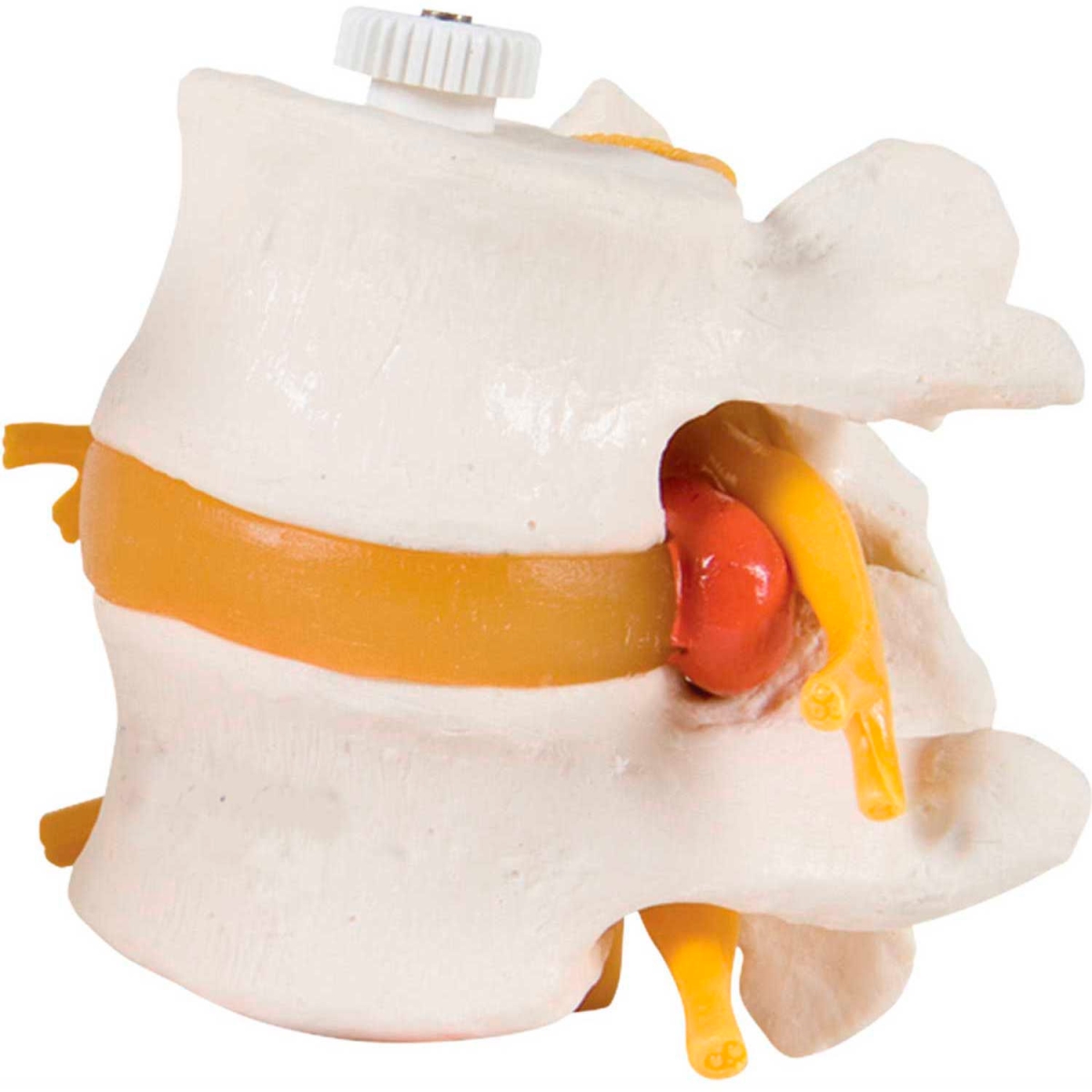 B2138085 3B Anatomical Model - 2 Lumbar Vertebrae with Prolapsed Disc, Flexibly Mounted