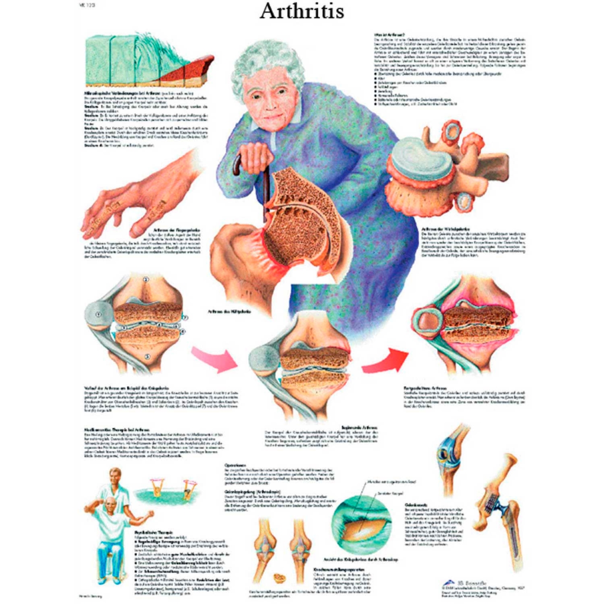 B2138129 3B Anatomical Chart - Arthritis, Paper