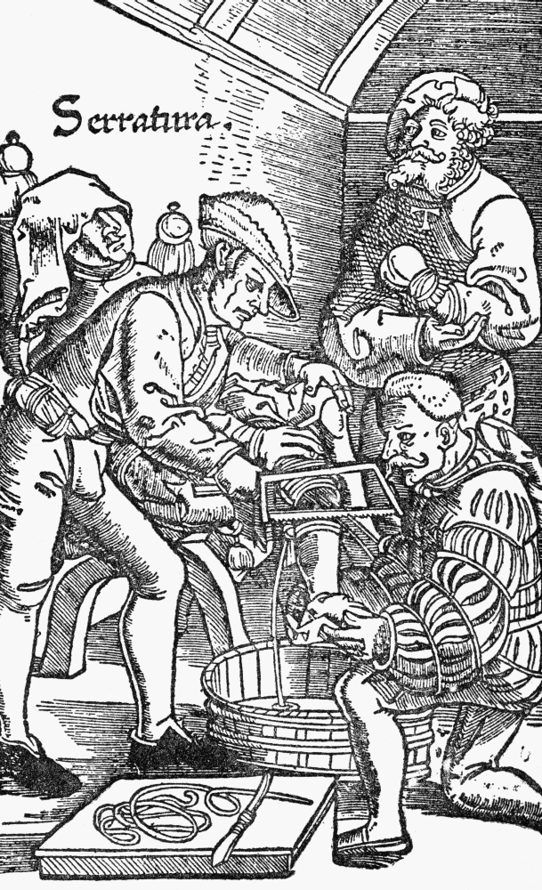 Sixteenth Century Amputation Poster Print - Large