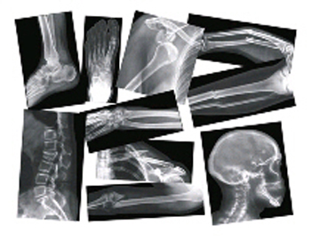 Picture of Roylco R-5914 Broken Bone Compound Fracture X-Rays